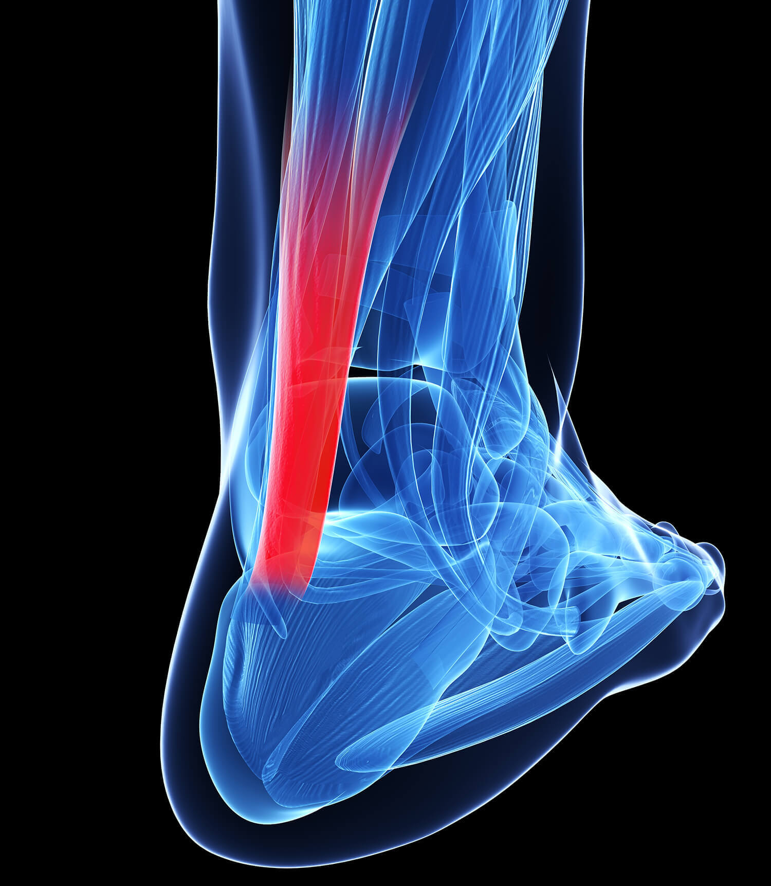Tratamento da tendinose lesões tendinosas Northeast Knee Joint