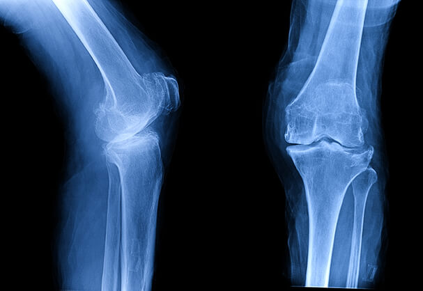 Five Tips to Relieve Your Osteoarthritis Pain