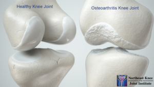 Healthy and OA Knee Joint