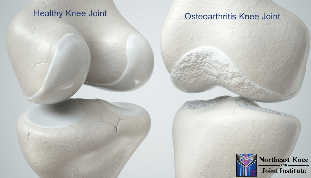 Weight Loss for Osteoarthritis Relief