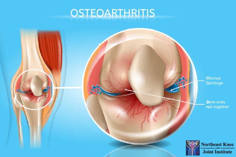 Hyaluronic Acid Injections Northeast Knee & Joint Institute