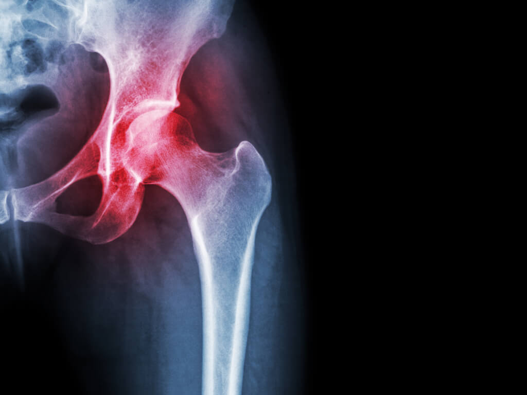 Hip pain that can be fixed with stem cell therapy.