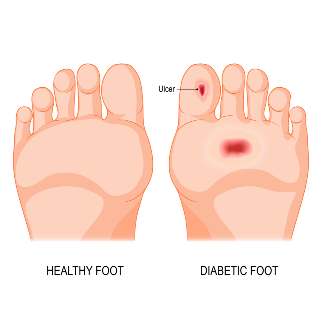 ULCERS - Diabetic (Neuropathic) Foot Ulcers