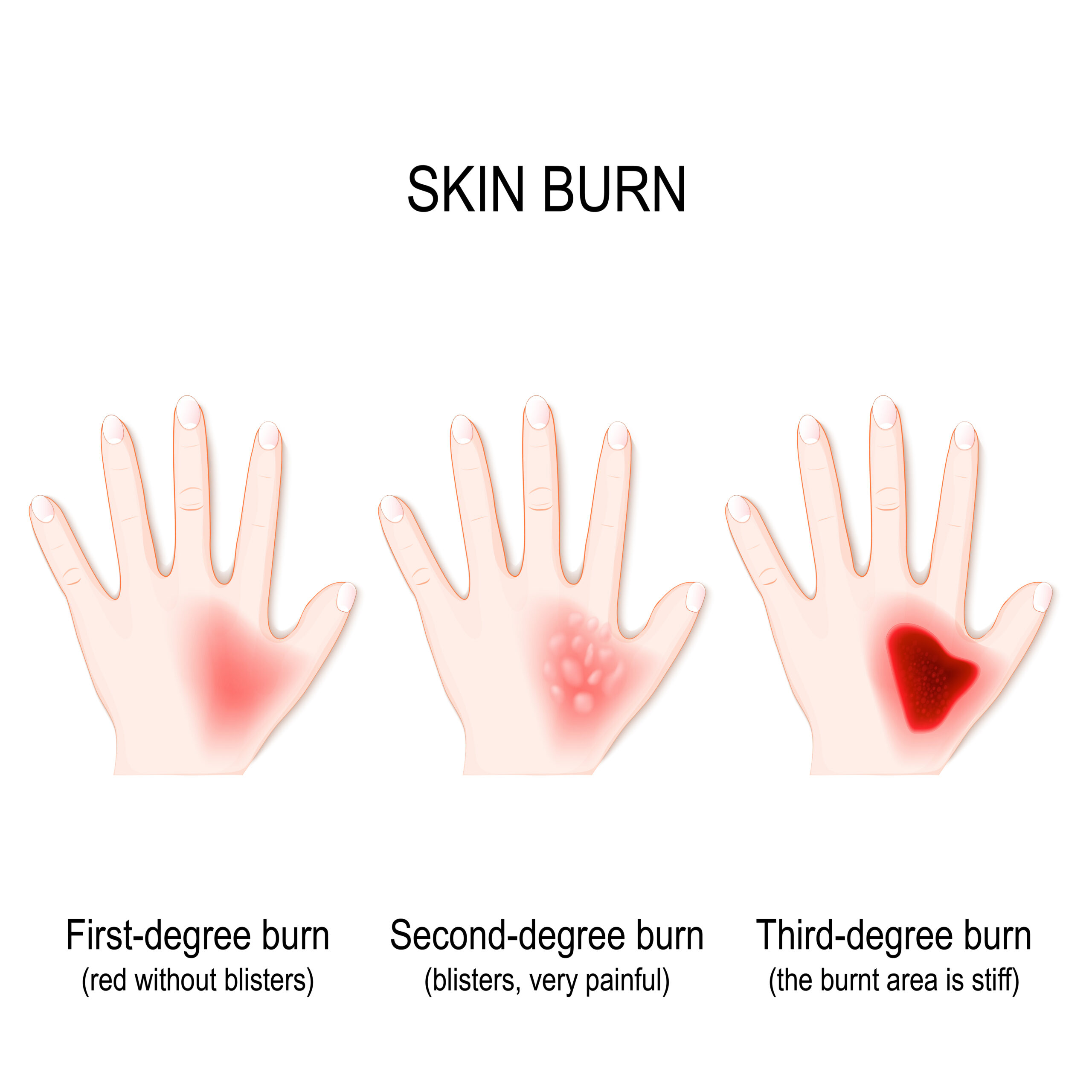 BURNS - Chemical burns from cement, acids, or drain cleaners